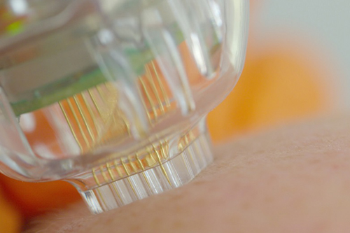 MAszyna do zabiegu radiofrekwencji mikroigłowej - spowalnianie starzenia