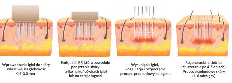 Radiofrekwencja Mikroiglowa - jak działa zabieg