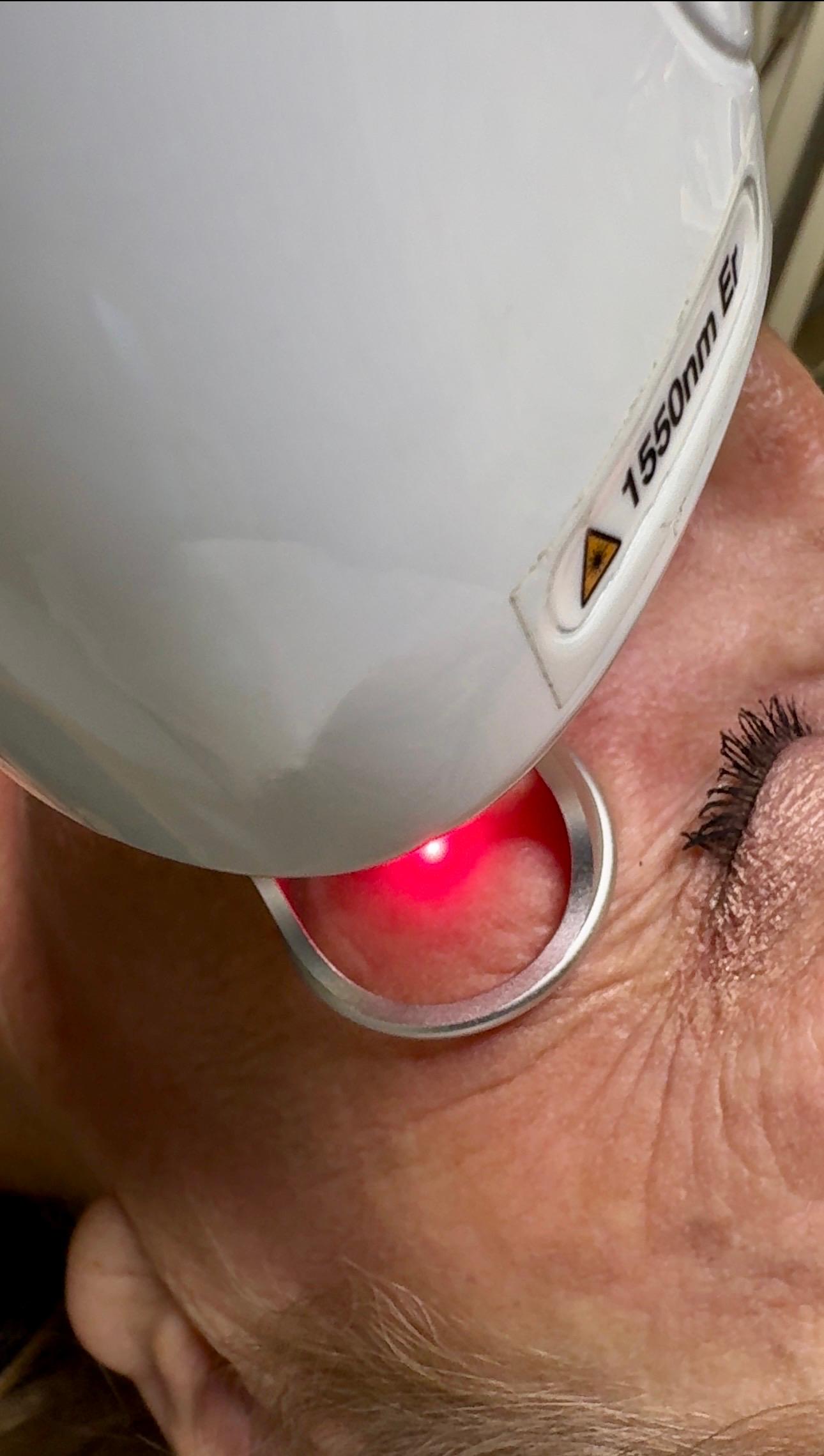 Laseroterapia Er-Glass w Studio Sztuka